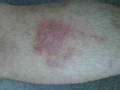 Bed Bugs Dangerous photos
