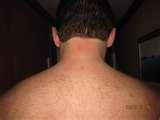 Bed Bugs Ncl