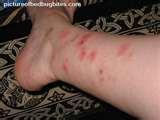 photos of Bed Bugs Hurt