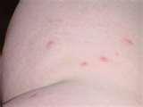 photos of Bed Bugs 923