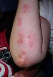 images of Bed Bugs Pennsylvania