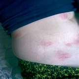 Bed Bugs Abroad photos