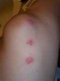 pictures of Bed Bugs Symptoms Bite