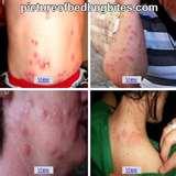 Bed Bugs Symptoms Bite images