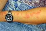 Bed Bugs Symptoms Bite photos