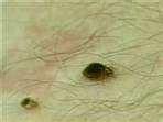 pictures of Bed Bugs Msnbc