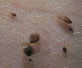 Bed Bugs Snopes