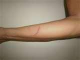 Bed Bugs Vietnam pictures