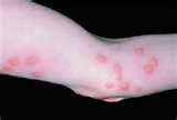 Bed Bugs Of Bites On Humans pictures