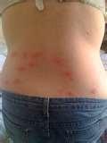 Bed Bugs Of Bites On Humans photos