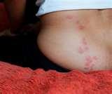 Do Bed Bugs Carry Diseases images