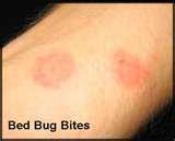 images of Bed Bugs Bruising