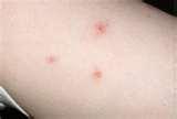 pictures of Bed Bugs Bruising