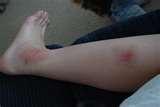 pictures of Bed Bugs Bruising