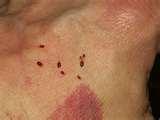 Are Bed Bugs Flat photos