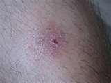 images of Bed Bugs Bruising