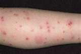Bed Bugs Vs Chiggers pictures