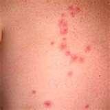 photos of Bed Bugs Vs Chiggers