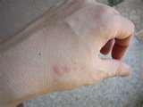 Bed Bugs Ny Hotels images