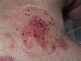 Bed Bugs Nymph pictures