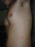 Bed Bugs Knees images