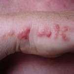 Bed Bugs Impetigo
