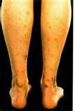 photos of Bed Bugs Impetigo