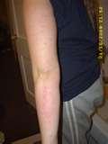 Bed Bugs Impetigo pictures