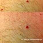 My Bed Bugs Tv Show