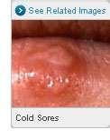 Bed Bugs Swollen Lymph Nodes pictures