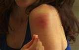 images of Bed Bugs Swollen Lymph Nodes