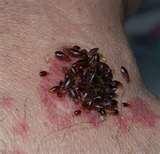 Bed Bugs Prevention Hotels images