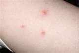 Bed Bugs In Phoenix Az photos