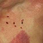 photos of Bed Bugs Nd