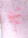 Bed Bugs Itchy photos
