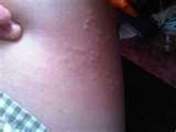 Bed Bugs Itchy pictures