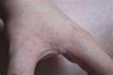 Bed Bugs Bug Bites images
