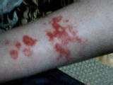 Bed Bugs Bug Bites images