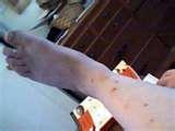 pictures of Bed Bugs Bug Bites