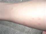 images of Bed Bugs Microwave