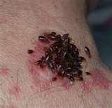 photos of Bed Bugs Treatment Of Bites