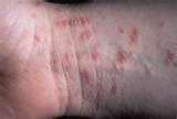 photos of Bed Bugs Skin Lesions