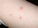pictures of Bed Bugs Psychological Trauma