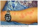 Bed Bugs Are Attracted To photos