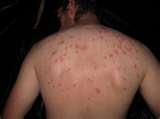 images of Bed Bugs Are Attracted To
