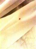Bed Bugs Effect On Skin