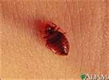images of Bed Bugs Rss Feed