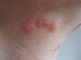 Bed Bugs Bed Bugs photos