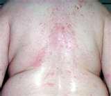 Www Bed Bugs Com Pictures photos