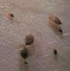 Bed Bugs Virginia Beach images